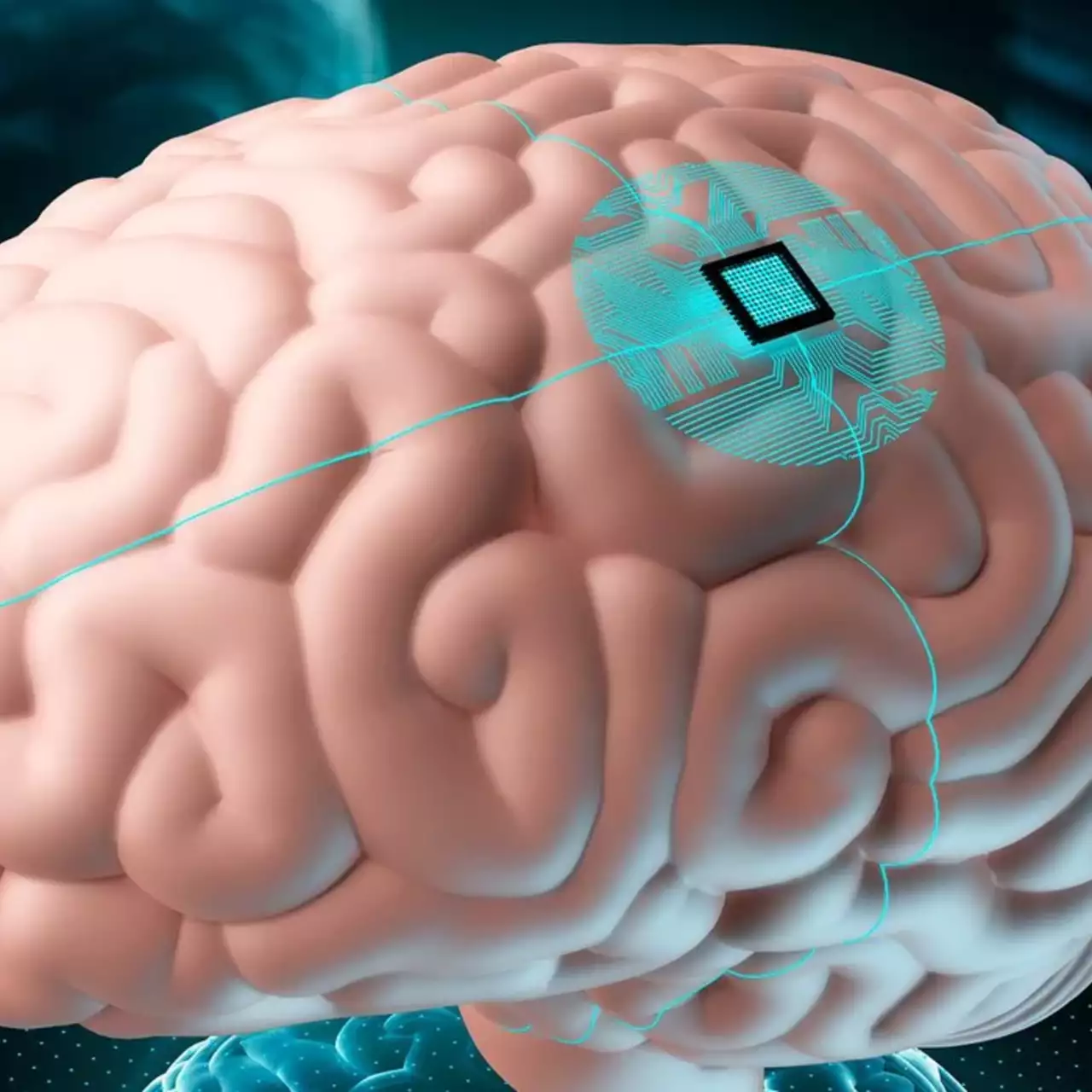 Neuralink ищет еще кандидатов на вживление чипов в мозг